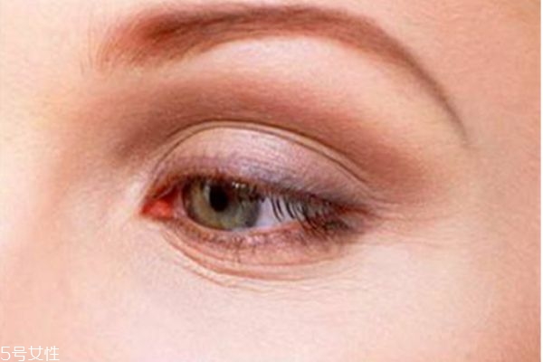 內切眼袋多久可以消腫 內切眼袋手術用拆線嗎 內切眼袋多久可以消腫 內切眼袋手術用拆線嗎