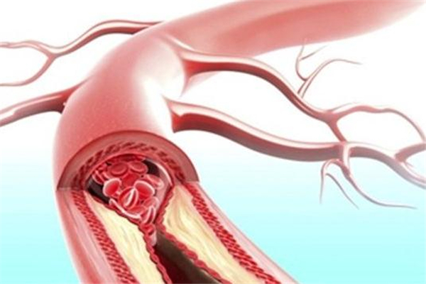 動脈粥樣硬化的原因與預防 動脈粥樣硬化的原因與預防