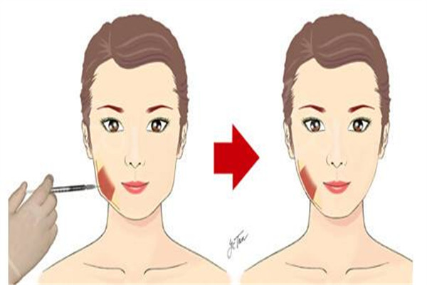 肉毒素有副作用嗎 怎么保養(yǎng)好 肉毒素有副作用嗎 怎么保養(yǎng)好