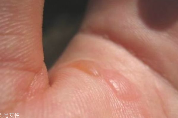 燙傷可以用香油嗎 燙傷后怎么好的快 燙傷可以用香油嗎 燙傷后怎么好的快