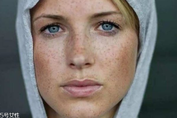 怎么區(qū)分斑和痣 3個(gè)方面來(lái)區(qū)分