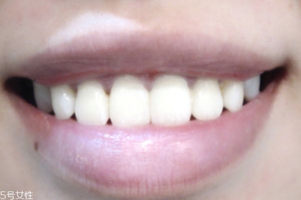 美牙儀可以天天用嗎 牙齒美白要謹慎