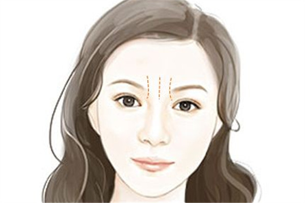 川字紋形成的原因是什么 原因是這樣 川字紋形成的原因是什么 原因是這樣