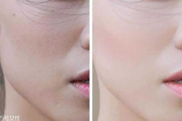 臉部皮膚粗糙怎么辦 臉部皮膚粗糙如何改善 臉部皮膚粗糙怎么辦 臉部皮膚粗糙如何改善