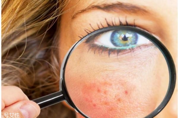 臉上經(jīng)常去角質(zhì)好嗎 去角質(zhì)必知小常識 臉上經(jīng)常去角質(zhì)好嗎 去角質(zhì)必知小常識