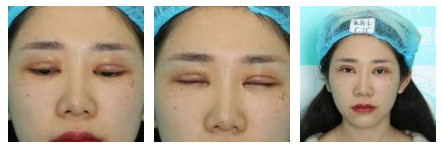 開(kāi)內(nèi)眼角要多久恢復(fù) 依個(gè)人體質(zhì)而定