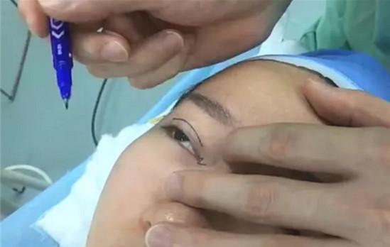 開(kāi)內(nèi)眼角要多久恢復(fù) 依個(gè)人體質(zhì)而定