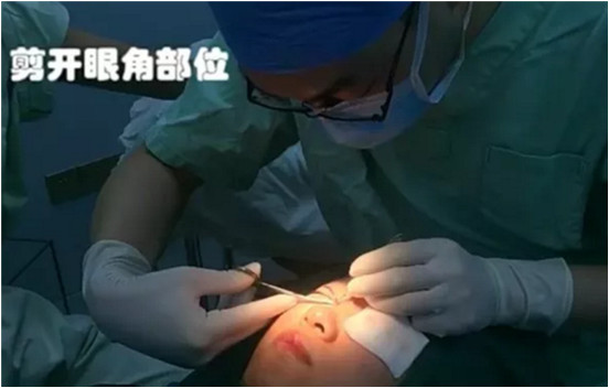 開(kāi)內(nèi)眼角要多久恢復(fù) 依個(gè)人體質(zhì)而定