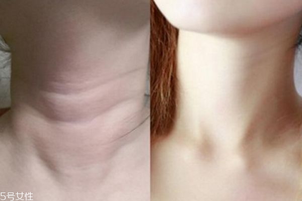 有頸紋了怎么辦 如何改善頸紋 有頸紋了怎么辦 如何改善頸紋