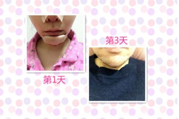 墊下巴能改變臉型嗎 墊下巴后恢復(fù)過程 墊下巴能改變臉型嗎 墊下巴后恢復(fù)過程