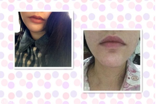 墊下巴能改變臉型嗎 墊下巴后恢復(fù)過程 墊下巴能改變臉型嗎 墊下巴后恢復(fù)過程