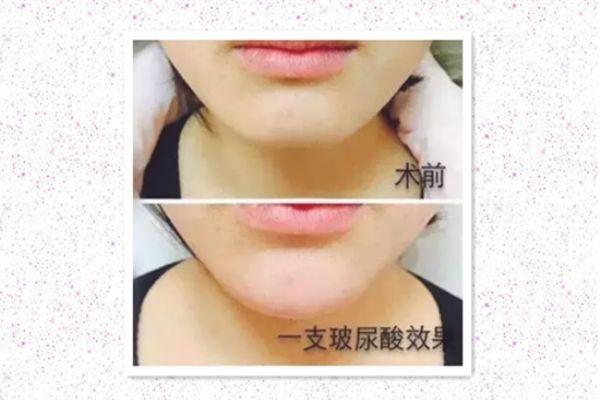 玻尿酸打下巴怎么打的 玻尿酸打下巴是什么感覺 玻尿酸打下巴怎么打的 玻尿酸打下巴是什么感覺