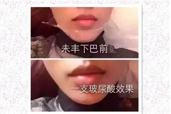 玻尿酸打下巴怎么打的 玻尿酸打下巴是什么感覺 玻尿酸打下巴怎么打的 玻尿酸打下巴是什么感覺