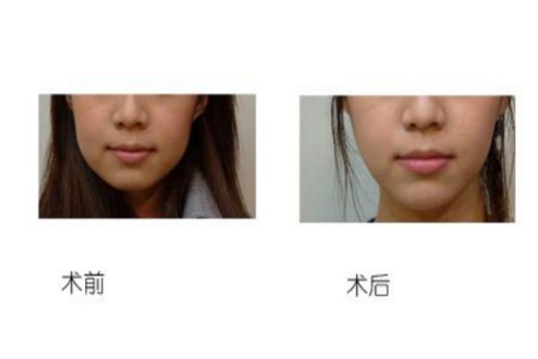 墊下巴前后對比照片 墊下巴的優(yōu)缺點(diǎn) 墊下巴前后對比照片 墊下巴的優(yōu)缺點(diǎn)