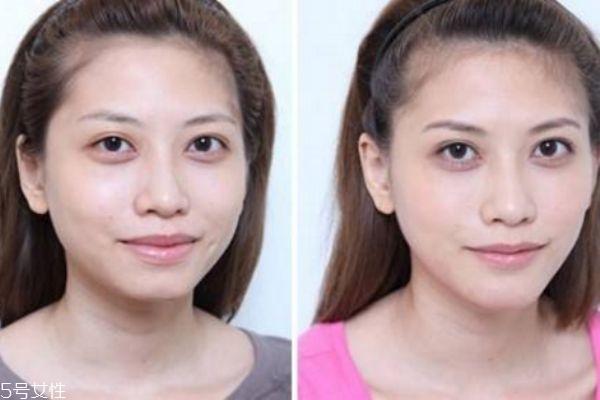 墊下巴前后對比照片 墊下巴的優(yōu)缺點(diǎn) 墊下巴前后對比照片 墊下巴的優(yōu)缺點(diǎn)