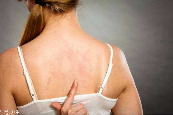 背上長痘痘怎么消除 背上長痘痘的原因和解決方法 背上長痘痘怎么消除 背上長痘痘的原因和解決方法