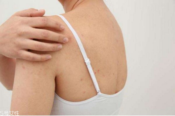 背上長痘痘怎么消除 背上長痘痘的原因和解決方法 背上長痘痘怎么消除 背上長痘痘的原因和解決方法