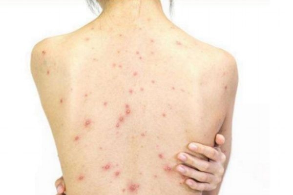 背上長痘痘怎么消除 背上長痘痘的原因和解決方法 背上長痘痘怎么消除 背上長痘痘的原因和解決方法