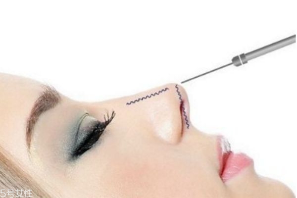 硅膠隆鼻取出多久消腫 鼻子硅膠取出親身經(jīng)歷 硅膠隆鼻取出多久消腫 鼻子硅膠取出親身經(jīng)歷