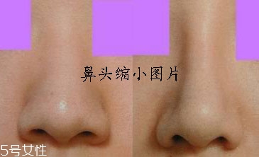 鼻頭縮小術(shù)有風(fēng)險(xiǎn)嗎