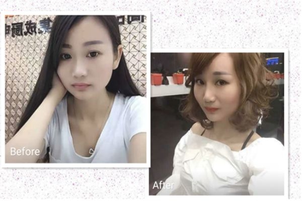 鼻翼縮小手術前后對比照片 縮鼻孔手術對比照片 鼻翼縮小手術前后對比照片 縮鼻孔手術對比照片