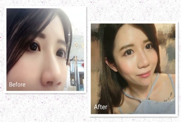 鼻翼縮小手術前后對比照片 縮鼻孔手術對比照片 鼻翼縮小手術前后對比照片 縮鼻孔手術對比照片