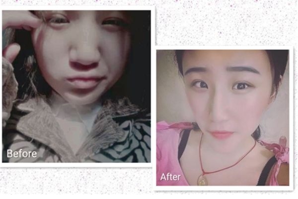 鼻翼縮小手術前后對比照片 縮鼻孔手術對比照片 鼻翼縮小手術前后對比照片 縮鼻孔手術對比照片