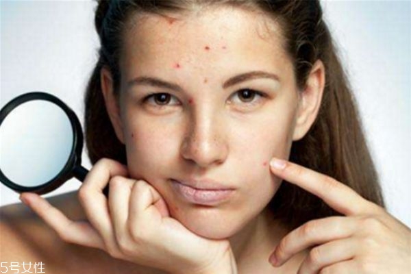 用激光去痘印好嗎 激光去痘印的原理 用激光去痘印好嗎 激光去痘印的原理