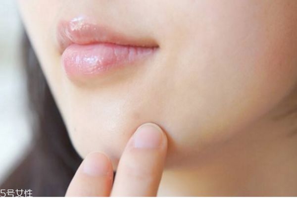 用激光去痘印好嗎 激光去痘印的原理 用激光去痘印好嗎 激光去痘印的原理