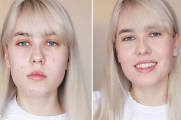 用激光去痘印好嗎 激光去痘印的原理 用激光去痘印好嗎 激光去痘印的原理