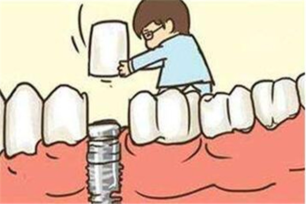 種植牙有哪幾種材料 種植牙選什么材料好 種植牙有哪幾種材料 種植牙選什么材料好