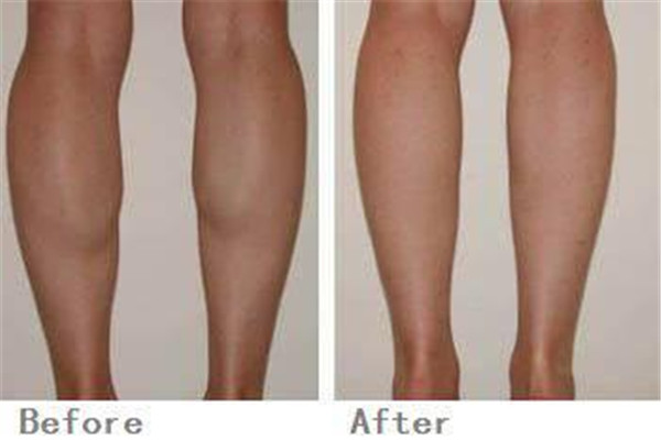 瘦腿針的危害是什么 瘦腿針有什么危害嗎 瘦腿針的危害是什么 瘦腿針有什么危害嗎