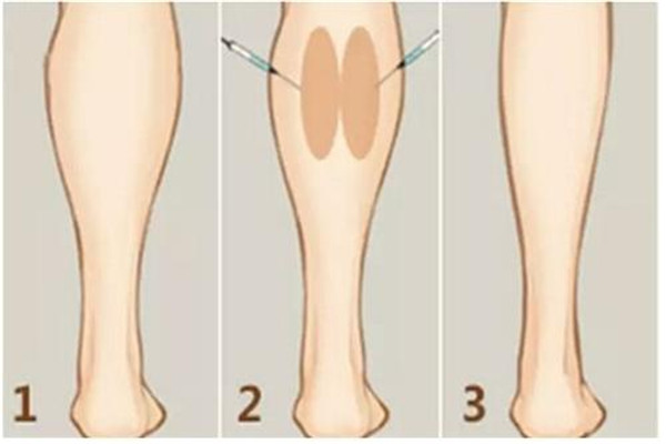 瘦腿針要打幾次 瘦腿針最少需要打幾次 瘦腿針要打幾次 瘦腿針最少需要打幾次