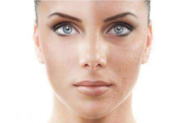 果酸換膚多少錢一次 正規(guī)醫(yī)院果酸換膚價格 果酸換膚多少錢一次 正規(guī)醫(yī)院果酸換膚價格