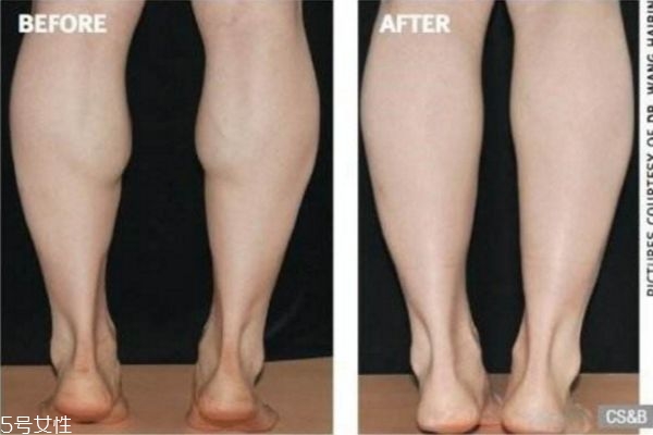 肌肉腿怎么形成的 肌肉型小腿形成原因 肌肉腿怎么形成的 肌肉型小腿形成原因