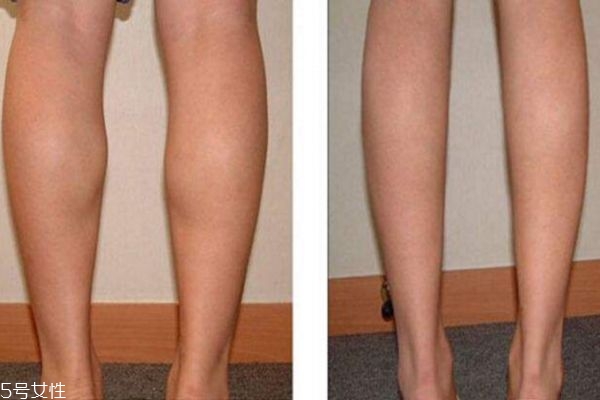肌肉腿怎么形成的 肌肉型小腿形成原因 肌肉腿怎么形成的 肌肉型小腿形成原因