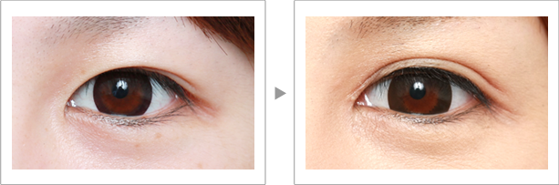 如何按摩眼睛變大 眼頭切開(kāi)風(fēng)按摩 如何按摩眼睛變大 眼頭切開(kāi)風(fēng)按摩