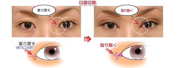 如何按摩眼睛變大 眼頭切開(kāi)風(fēng)按摩 如何按摩眼睛變大 眼頭切開(kāi)風(fēng)按摩