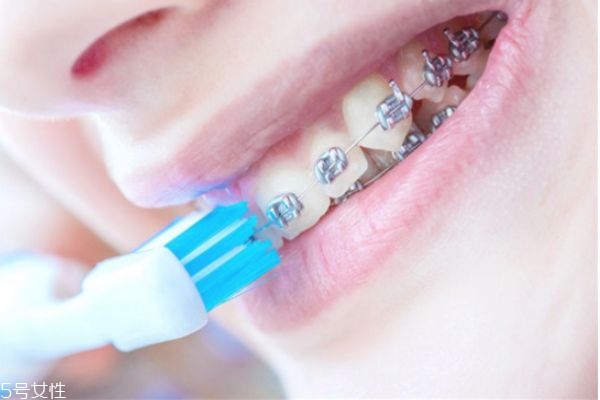 牙結(jié)石一定要洗牙嗎 自己如何去除牙結(jié)石 牙結(jié)石一定要洗牙嗎 自己如何去除牙結(jié)石