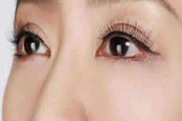 夏天適不適合割雙眼皮 什么時候是割雙眼皮最佳時間 夏天適不適合割雙眼皮 什么時候是割雙眼皮最佳時間