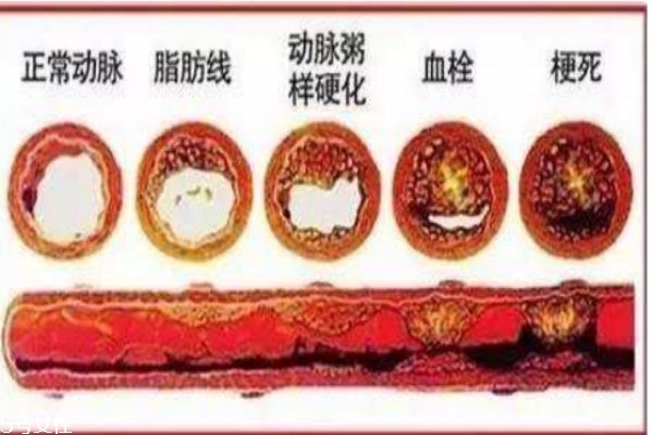 什么是高血脂 高血脂的危害是什么 什么是高血脂 高血脂的危害是什么