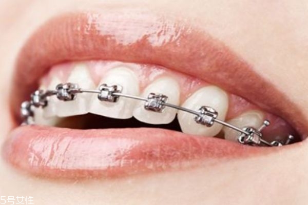 如何修正牙齒 牙齒不好看怎么辦 如何修正牙齒 牙齒不好看怎么辦
