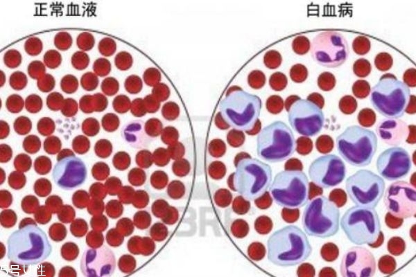 什么是白血病 患白血病的癥狀有什么 什么是白血病 患白血病的癥狀有什么