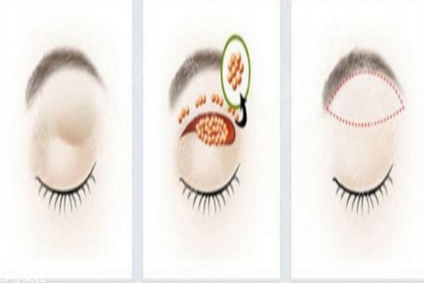 如何去腫眼泡 為什么人會(huì)有腫眼泡 如何去腫眼泡 為什么人會(huì)有腫眼泡