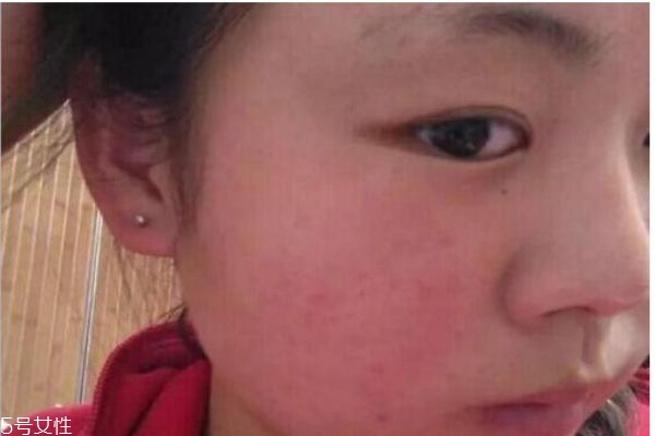 為什么臉上容易有紅血絲 如何消除紅血絲 為什么臉上容易有紅血絲 如何消除紅血絲