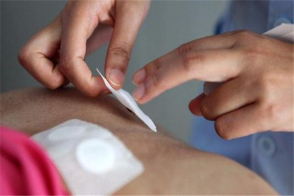 三伏貼配方都一樣嗎 三伏貼的作用是什么 三伏貼配方都一樣嗎 三伏貼的作用是什么