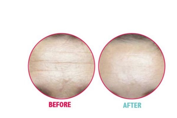 打一次除皺針可以維持多久呢 一針除皺針需要多少錢呢 打一次除皺針可以維持多久呢 一針除皺針需要多少錢呢