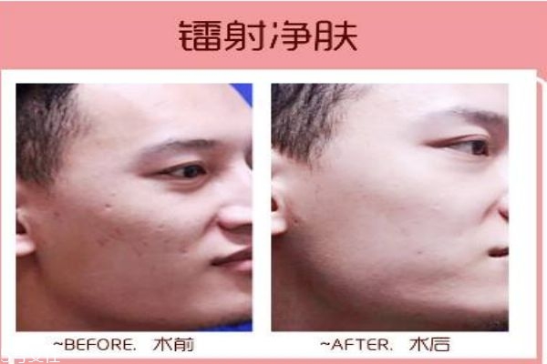 什么是鐳射凈膚呢 鐳射凈膚多少錢一次呢 什么是鐳射凈膚呢 鐳射凈膚多少錢一次呢