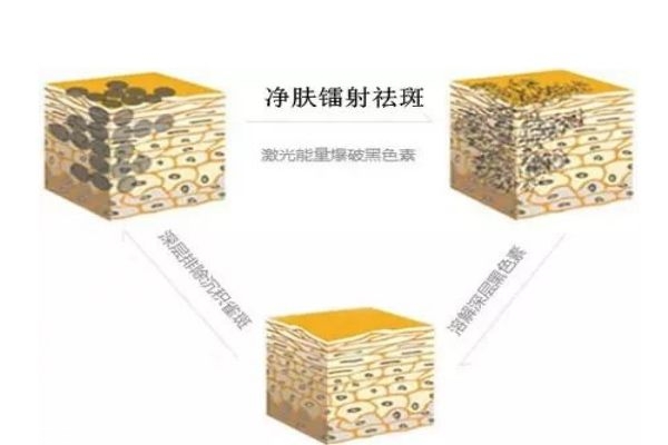 什么是鐳射凈膚呢 鐳射凈膚多少錢一次呢 什么是鐳射凈膚呢 鐳射凈膚多少錢一次呢