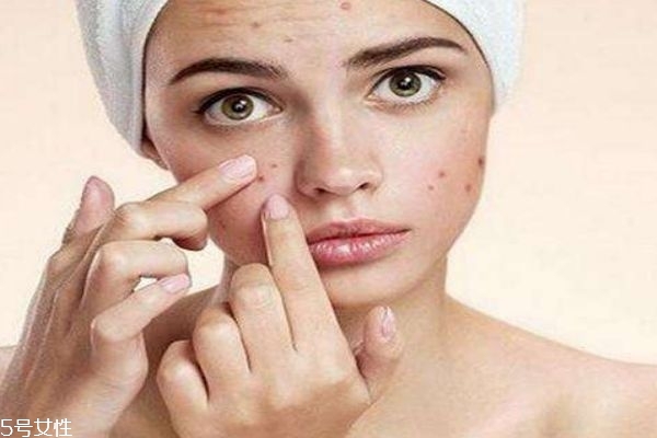 痘痘肌應該用什么面膜呢 痘痘肌適合什么洗面奶呢 痘痘肌應該用什么面膜呢 痘痘肌適合什么洗面奶呢
